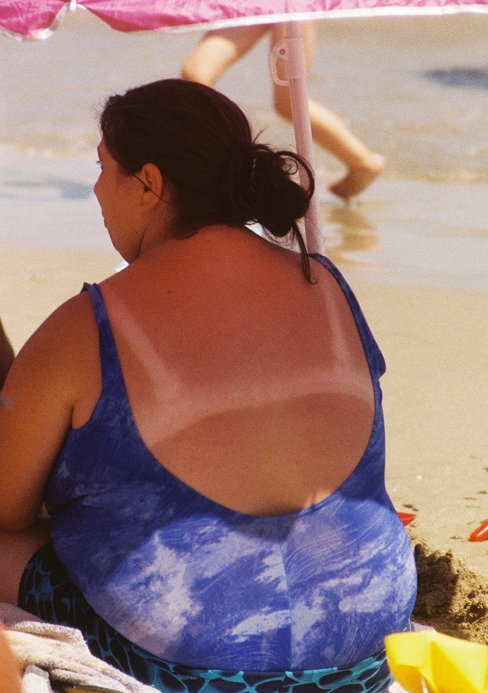 Eine Frau in einem blauen Badeanzug sitzt am Strand, man sieht einen Sonnenbrand auf ihrem Rücken 