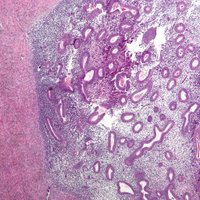 Nephron, Micrograph of endometriosis of the ovary. H&E stain, 2010 © https://commons.wikimedia.org/wiki/User:Nephron (GNU Free Documentation License)